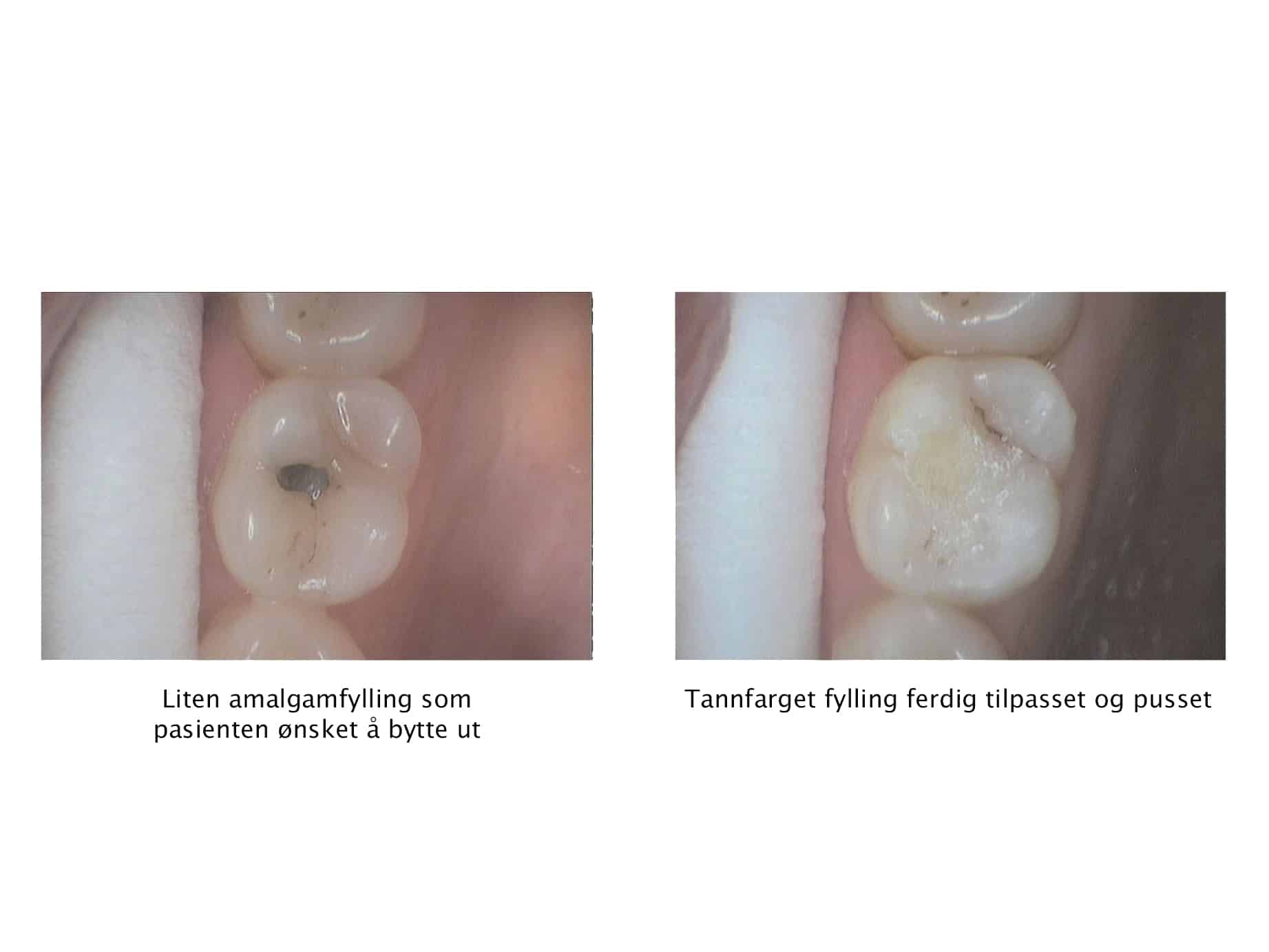 Galleri: Hos Kolbotn Tannklinikk erstattes gamle amalgamfyllinger med estetisk tannfarget fylling – trygg behandling i Kolbotn, Follo og Hauketo.