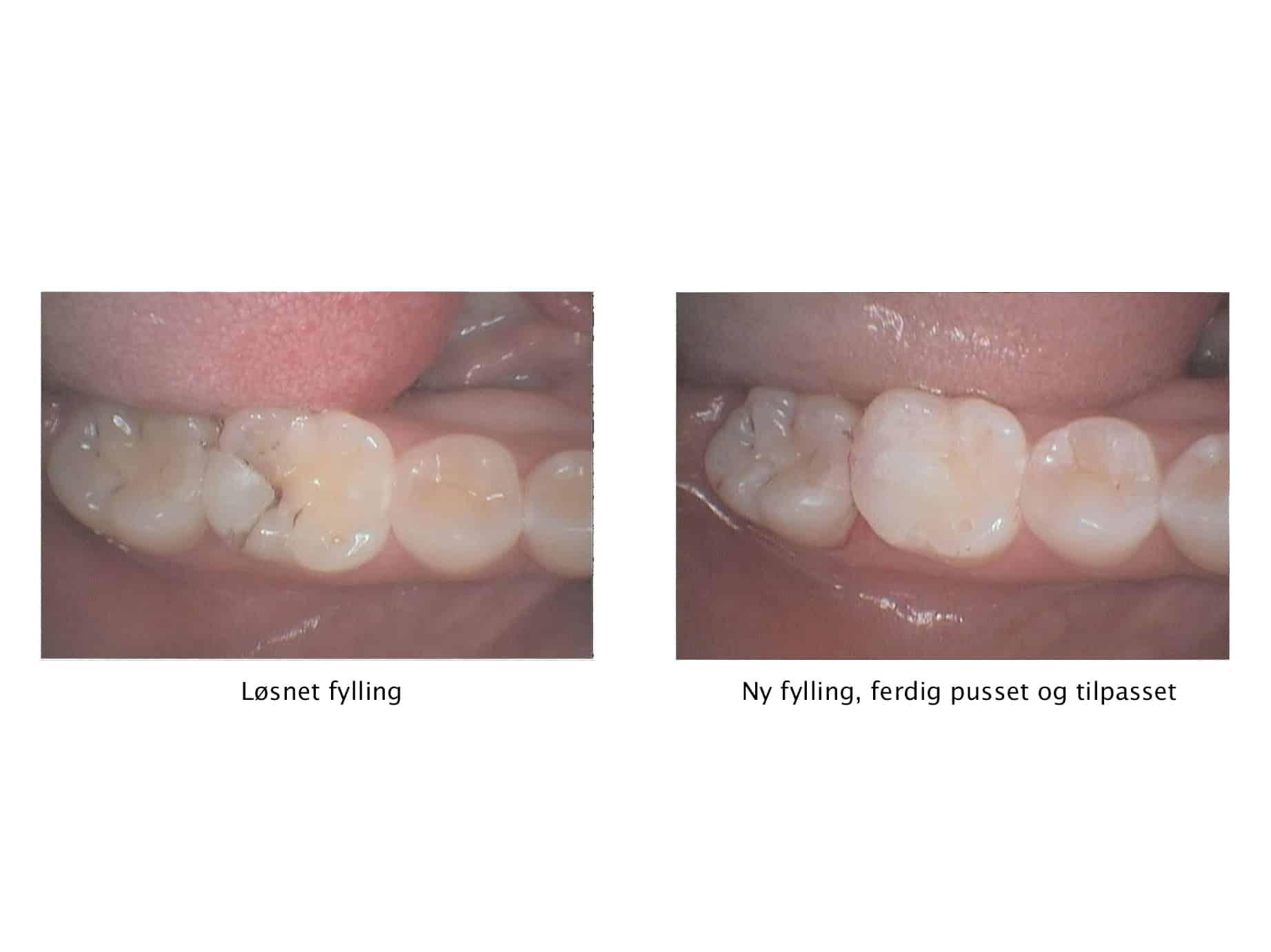 Galleri: På Kolbotn Tannklinikk erstatter tannleger en løs fylling med ny tannfarget løsning – behandling i Kolbotn, Vinterbro og Holmlia.