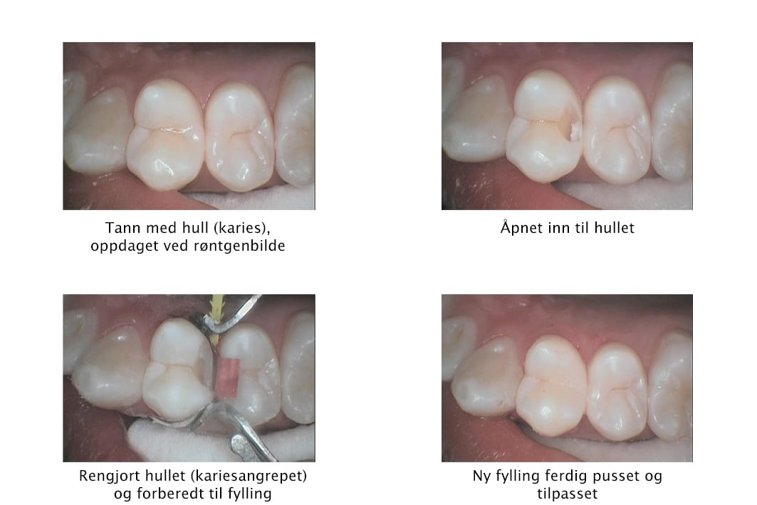 Galleri: Ved Kolbotn Tannklinikk repareres hull med tannfarget fylling – naturlig resultat i Kolbotn, Oppegård og Sofiemyr.