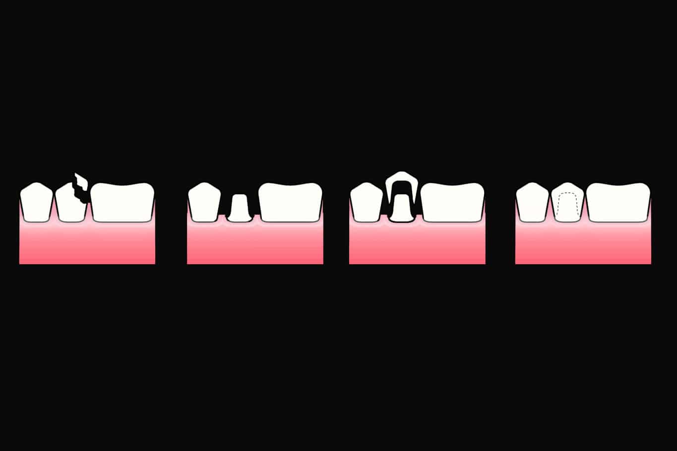 Hos Kolbotn Tannklinikk forbereder tannlegene en frakturert tann til kronebehandling – trygg behandling i Kolbotn, Follo og Oppegård.