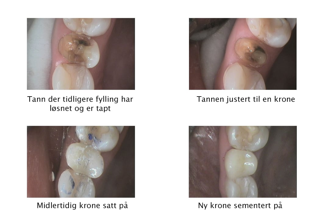 Galleri: Ved Kolbotn Tannklinikk bygges tann med tapt fylling opp med krone – pasienter i Kolbotn, Holmlia og Myrvoll.