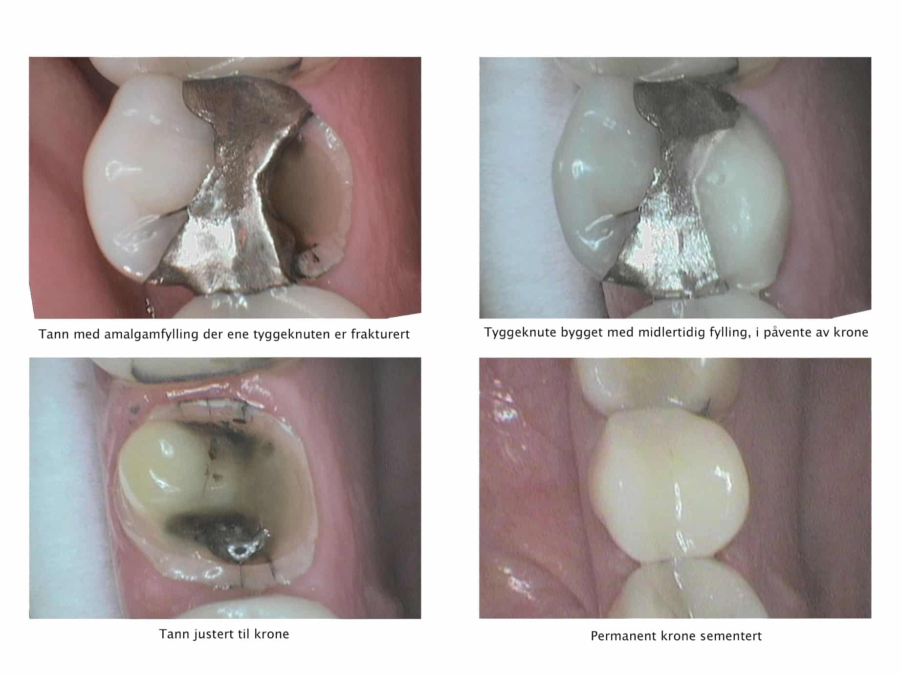 Galleri: Hos Kolbotn Tannklinikk repareres frakturert jeksel med krone – behandling i Kolbotn, Vinterbro og Sofiemyr.