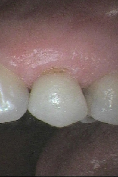 Før- og etterbilde: Hos Kolbotn Tannklinikk settes krone på tann med frakturert tyggeknute – moderne behandling i Kolbotn, Vinterbro og Nordstrand.