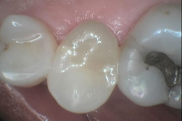 Før- og etterbilde: Tannkrone på liten jeksel hos Kolbotn Tannklinikk – trygg behandling i Kolbotn, Follo og Sofiemyr.