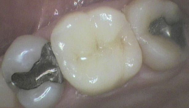 Før- og etterbilde: Ved Kolbotn Tannklinikk settes krone på jeksel etter tap av fylling – pasienter fra Kolbotn, Holmlia og Greverud.