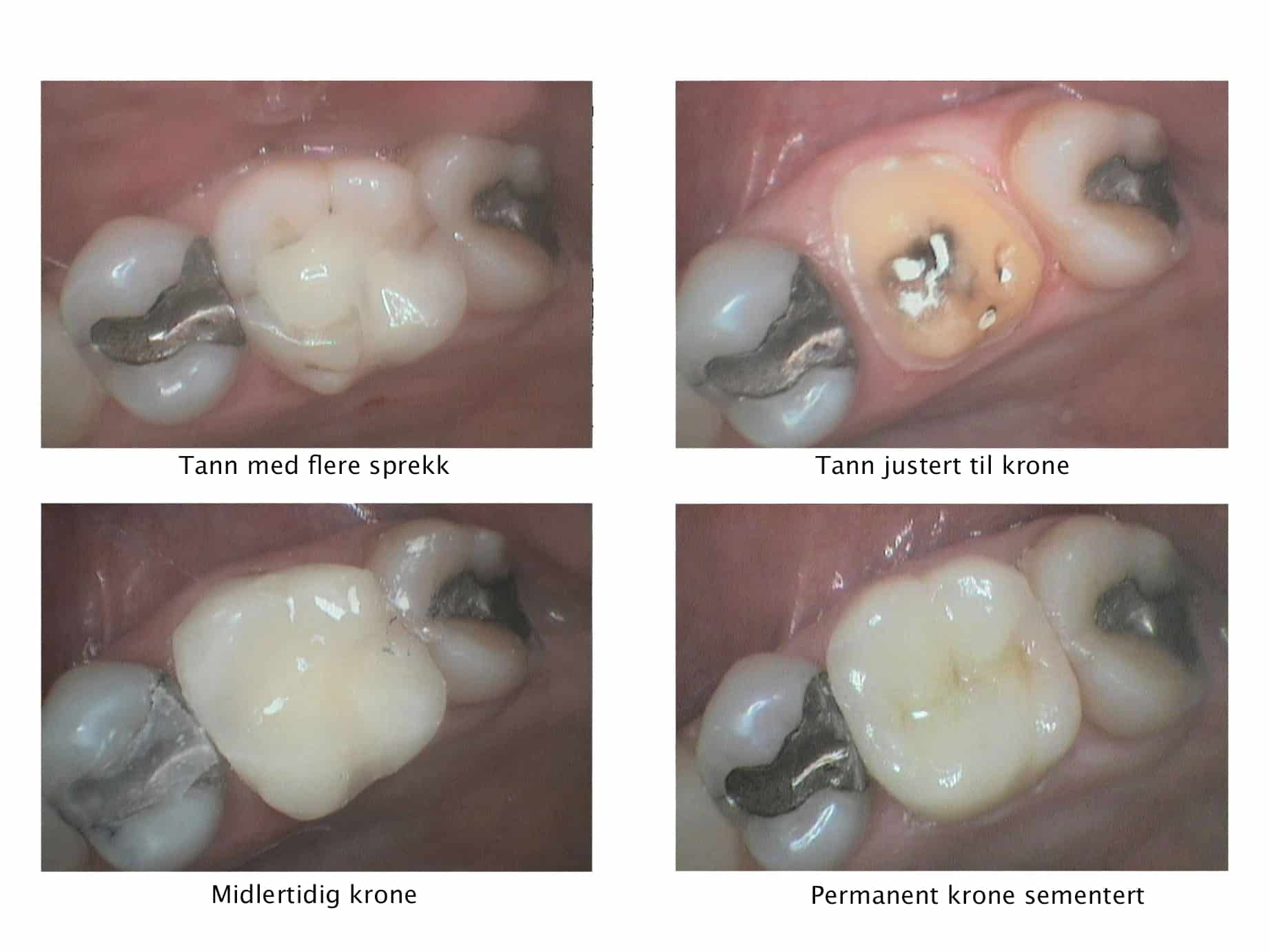 Galleri: Hos Kolbotn Tannklinikk bygges jeksel opp med tannkrone – naturlig resultat i Kolbotn, Vinterbro og Oppegård.