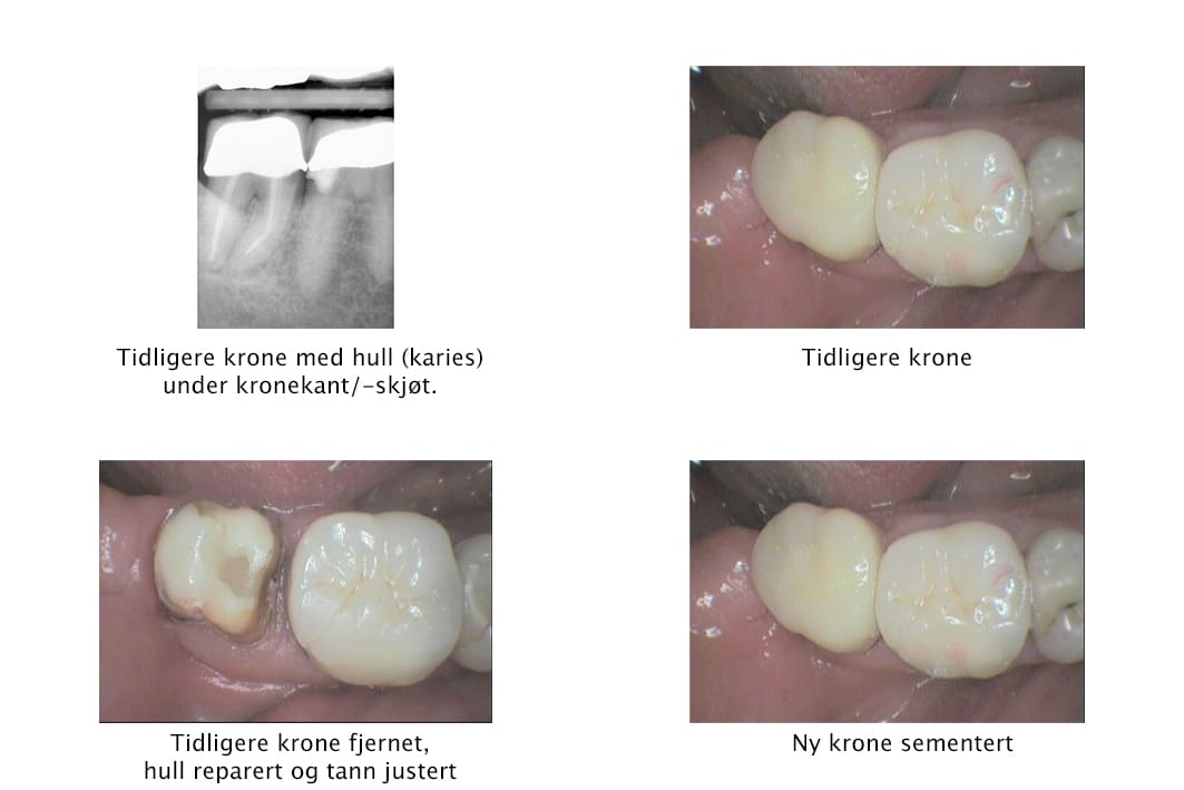 Galleri: På Kolbotn Tannklinikk skiftes ut gamle kroner med moderne løsninger – trygg behandling i Kolbotn, Follo og Nordstrand.