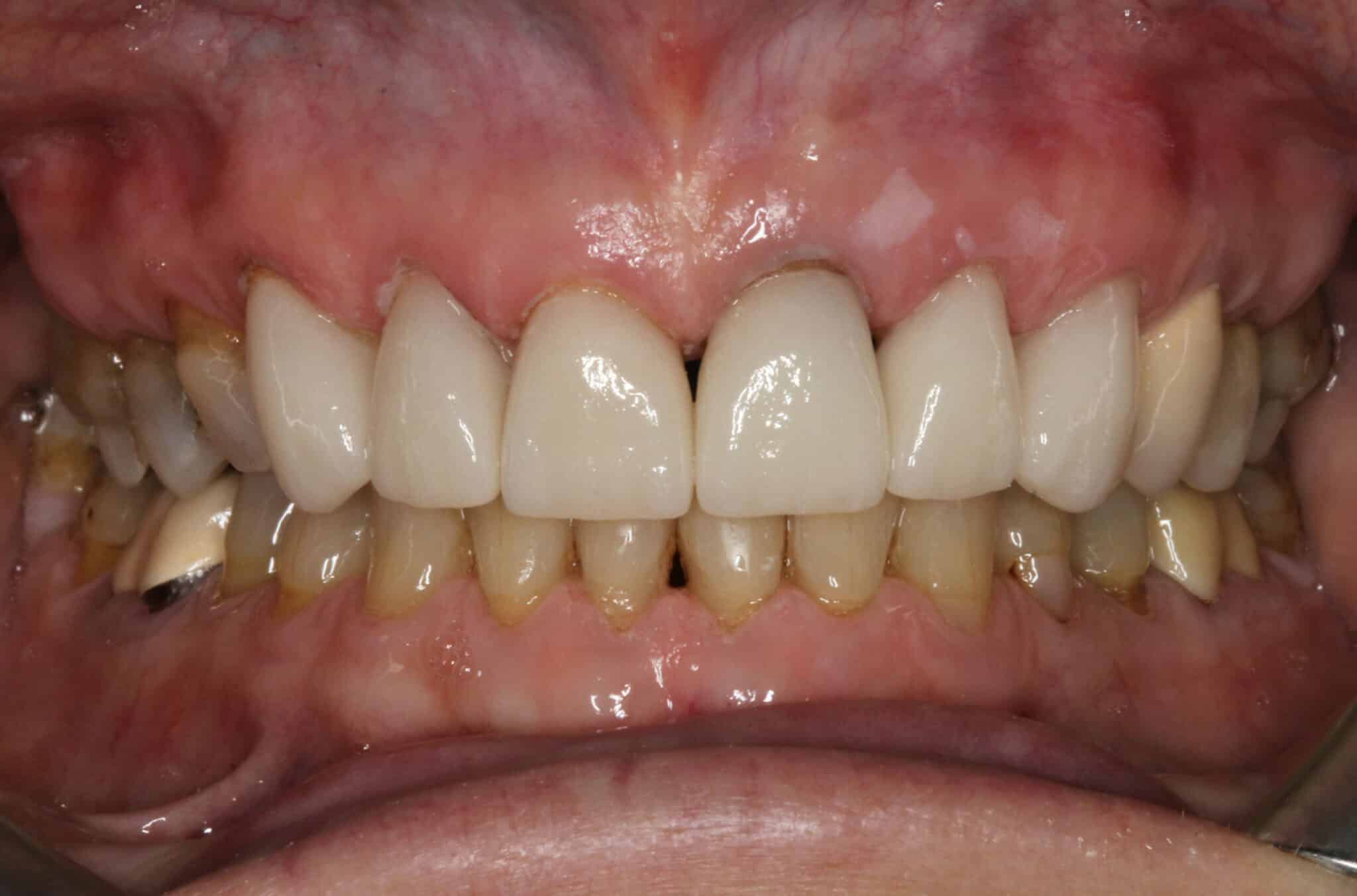 Før- og etterbilde: På Kolbotn Tannklinikk kombineres fasett/laminat og krone for estetisk forbedring – pasienter i Kolbotn, Oppegård, Follo og Nordstrand.