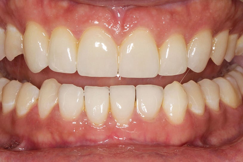 Før- og etterbilde: Tannlegene ved Kolbotn Tannklinikk bruker fasett/laminat for å korrigere form og farge på seks fortenner – behandling i Kolbotn, Follo og Myrvoll.