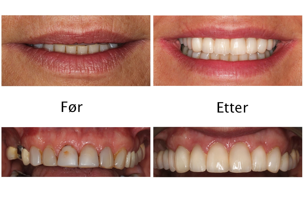 Galleri: Hos Kolbotn Tannklinikk behandles seks fortenner med fasetter for et naturlig smil – behandling i Kolbotn, Vinterbro og Sofiemyr.