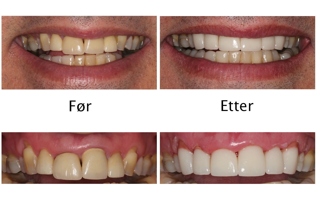 Galleri: Ved Kolbotn Tannklinikk kombineres fasett/laminat og krone for estetisk tannbehandling – Kolbotn, Follo, Nordstrand og Holmlia.
