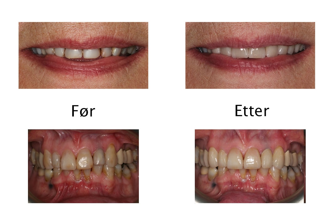 Galleri: Tannlegene ved Kolbotn Tannklinikk benytter fasetter på seks fortenner – behandling i Kolbotn, Oppegård og Greverud.