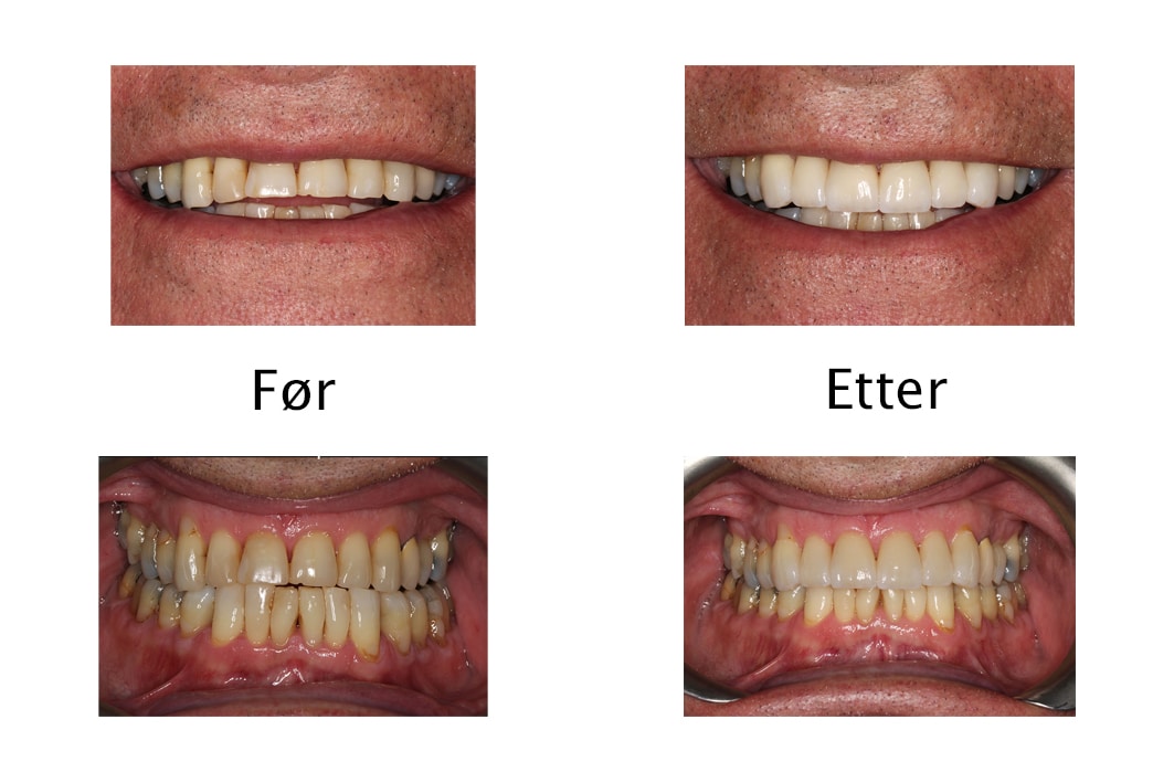 Galleri: På Kolbotn Tannklinikk brukes fasetter på seks fortenner i overkjeven – estetisk behandling i Kolbotn, Myrvoll og Holmlia.