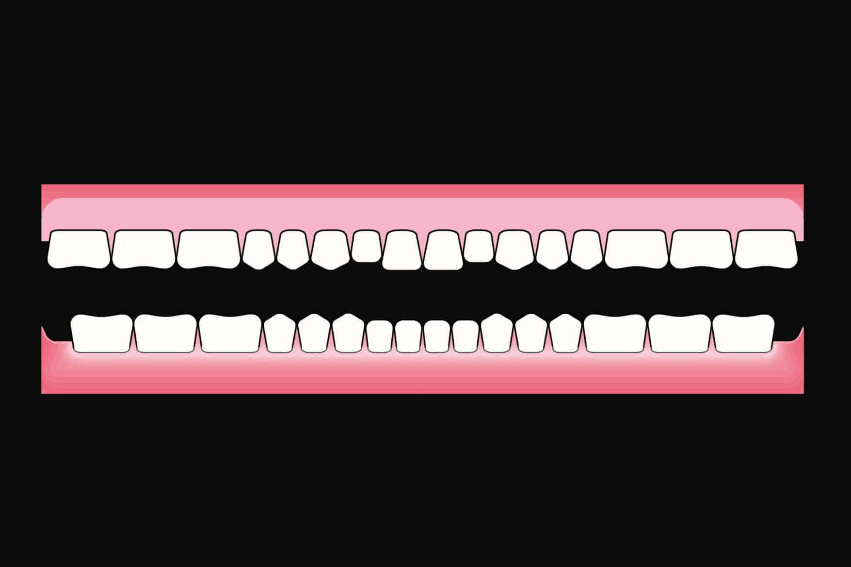 Før- og etterbilde: Hos Kolbotn Tannklinikk vises illustrasjon av helprotese som erstatter alle tennene i overkjeven – trygg behandling i Kolbotn, Follo og Oppegård.