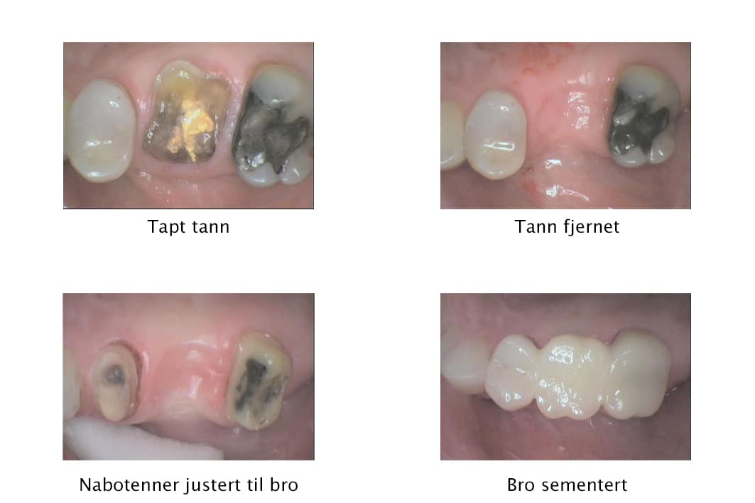 Galleri: Ved Kolbotn Tannklinikk brukes bro for å erstatte tapte tenner – trygg løsning i Kolbotn, Oppegård og Follo.