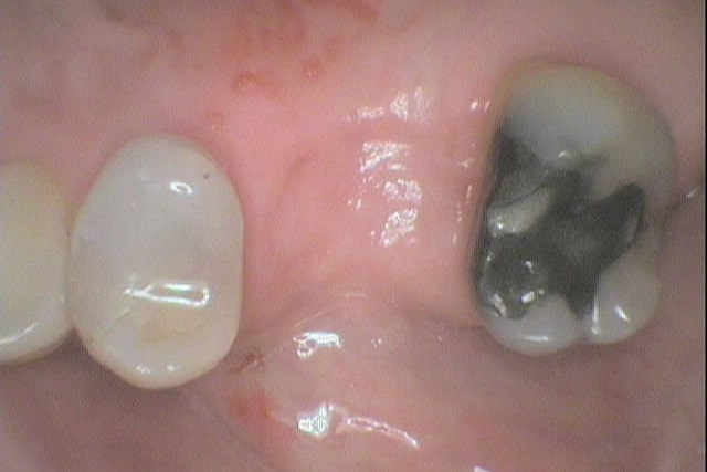 Bro erstatter manglende tann i tannrekken.