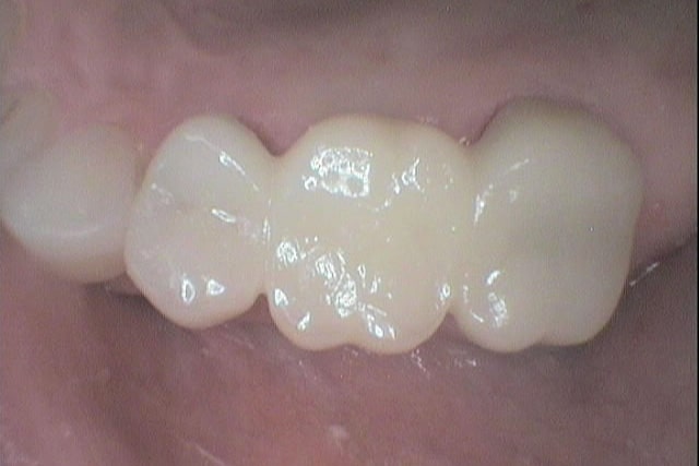 Før- og etterbilde: På Kolbotn Tannklinikk bygges en bro som erstatter en manglende tann – behandling i Kolbotn, Holmlia og Greverud.