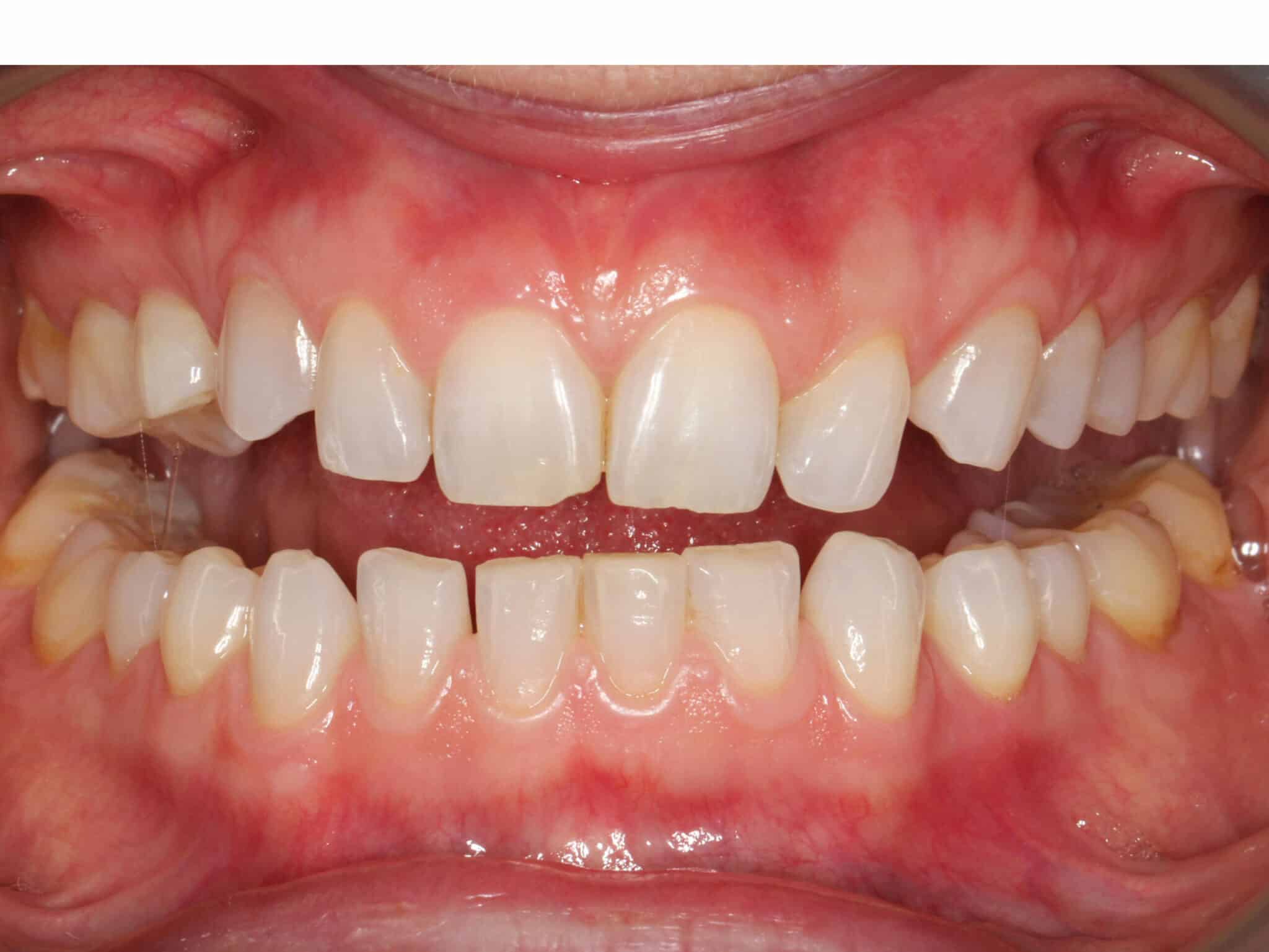 Før- og etterbilde: Hos Kolbotn Tannklinikk settes implantat som erstatter en hjørnetann – varig løsning i Kolbotn, Vinterbro og Nordstrand.