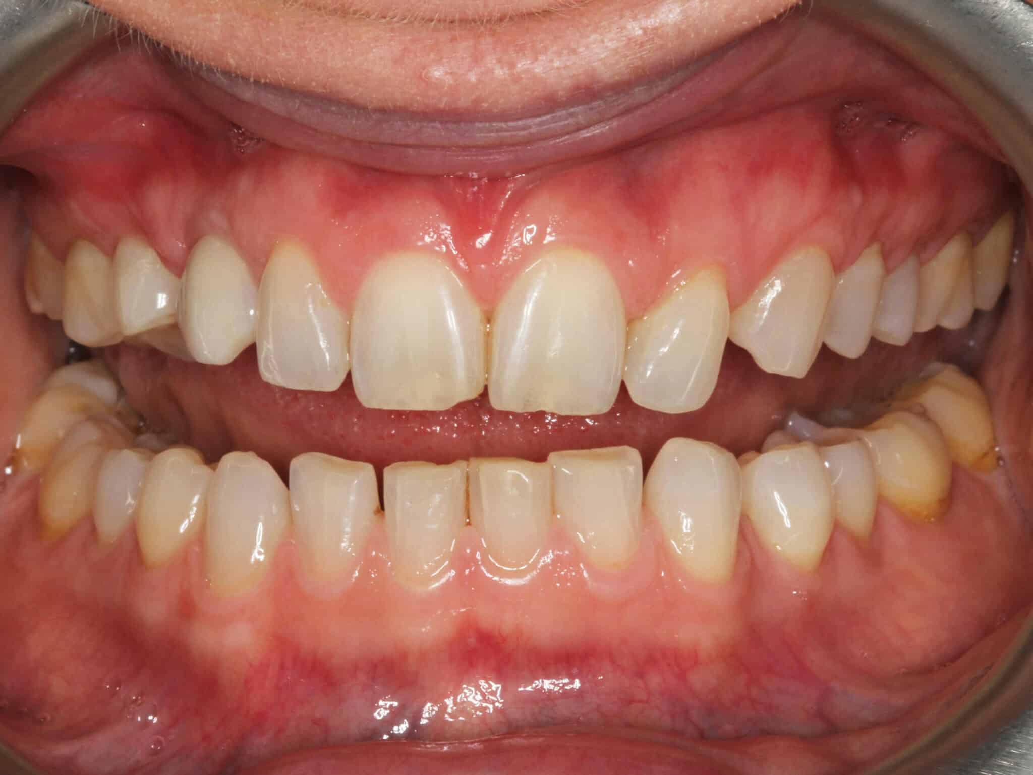 Før- og etterbilde: Hos Kolbotn Tannklinikk settes implantat som erstatter en hjørnetann – varig løsning i Kolbotn, Vinterbro og Nordstrand.