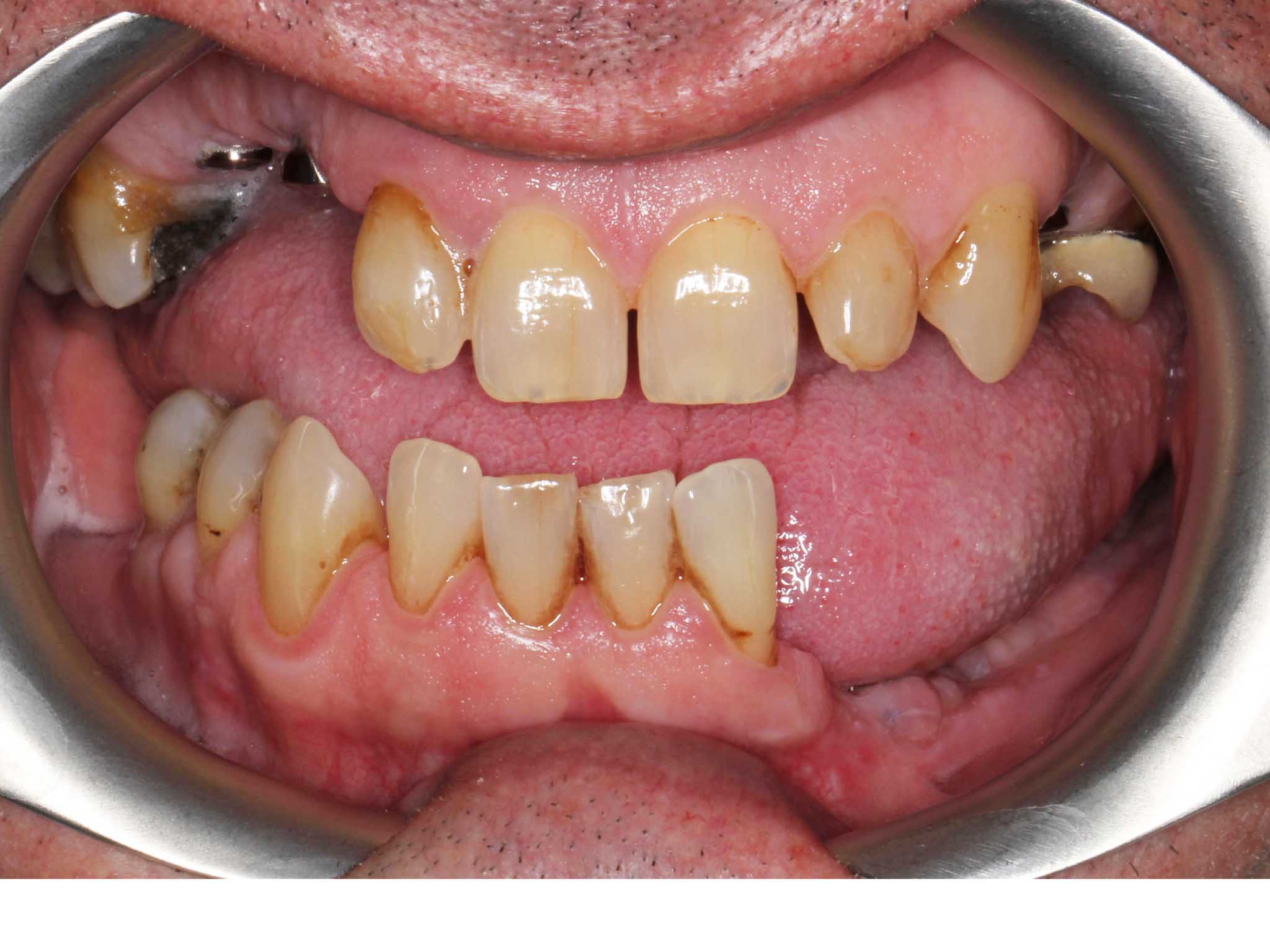 Før- og etterbilde: Hos Kolbotn Tannklinikk erstattes en tapt tann med implantat – Kolbotn, Follo, Oppegård og Holmlia.