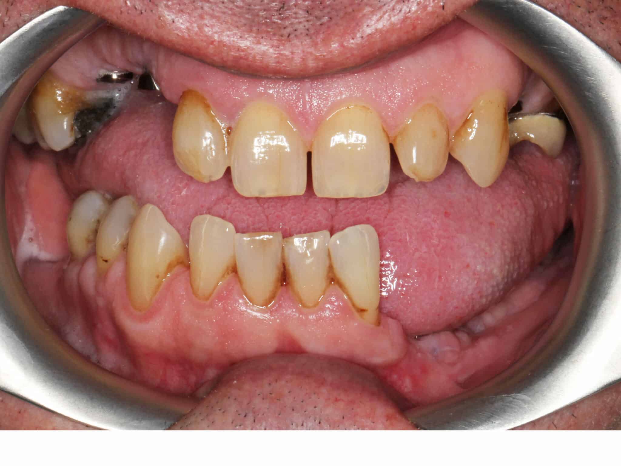 Før- og etterbilde: Hos Kolbotn Tannklinikk erstattes manglende tenner med implantat – varig og naturlig løsning i Kolbotn, Vinterbro og Myrvoll.