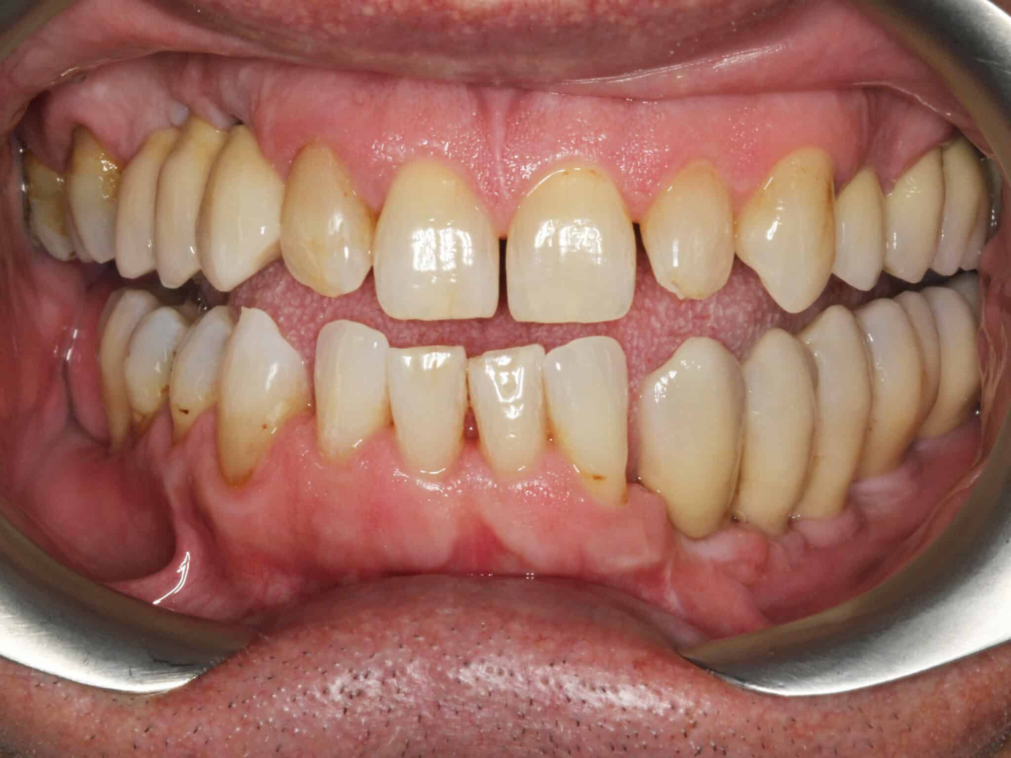 Før- og etterbilde: Hos Kolbotn Tannklinikk erstattes manglende tenner med implantat – varig og naturlig løsning i Kolbotn, Vinterbro og Myrvoll.