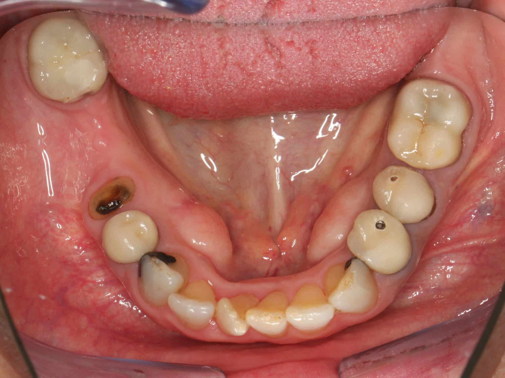 Underkjeve med bro som erstatter tapte tenner.