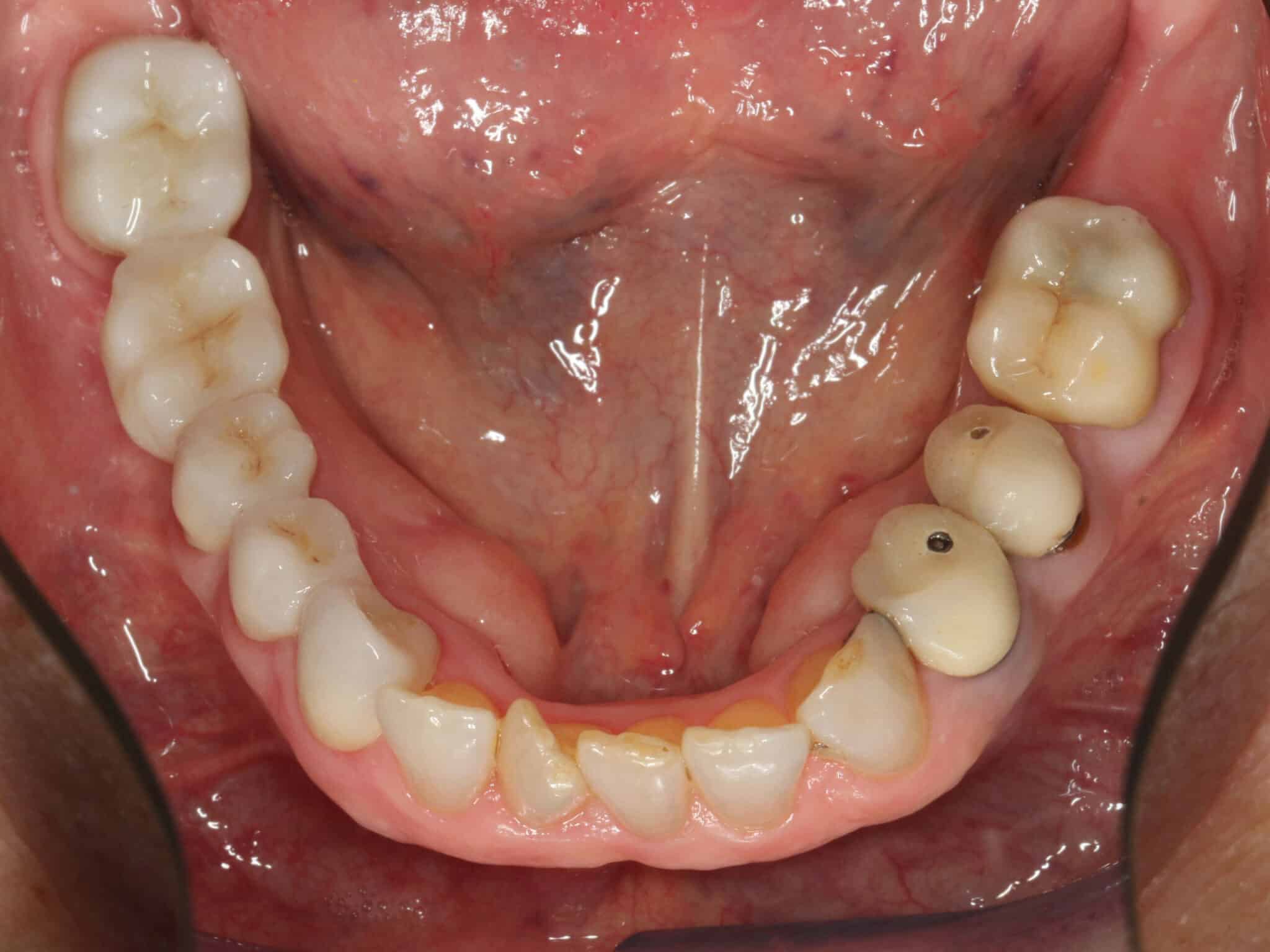 Før- og etterbilde: På Kolbotn Tannklinikk brukes bro til å erstatte tapte tenner – trygg behandling i Kolbotn, Follo og Holmlia.