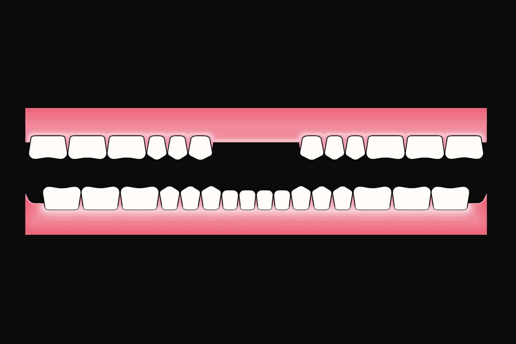 Før- og etterbilde: Hos Kolbotn Tannklinikk erstattes fire fortenner med en kromkobolt delprotese – trygg behandling i Kolbotn, Follo og Oppegård.