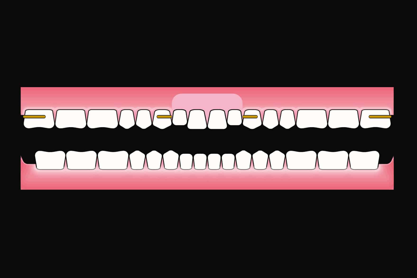 Før- og etterbilde: Hos Kolbotn Tannklinikk erstattes fire fortenner med en kromkobolt delprotese – trygg behandling i Kolbotn, Follo og Oppegård.