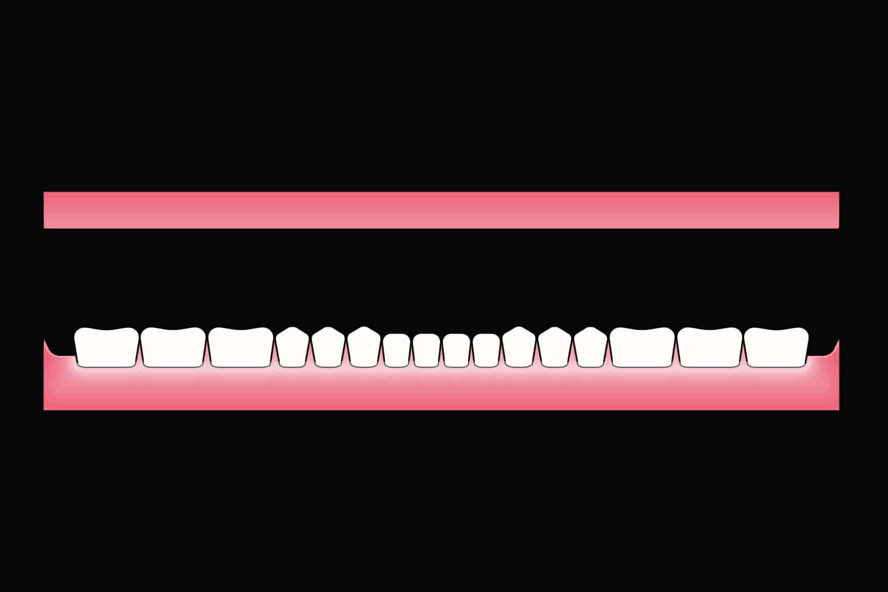 Før- og etterbilde: Hos Kolbotn Tannklinikk erstattes alle tennene i en kjeve med helprotese – løsning for pasienter i Kolbotn, Follo og Sofiemyr.
