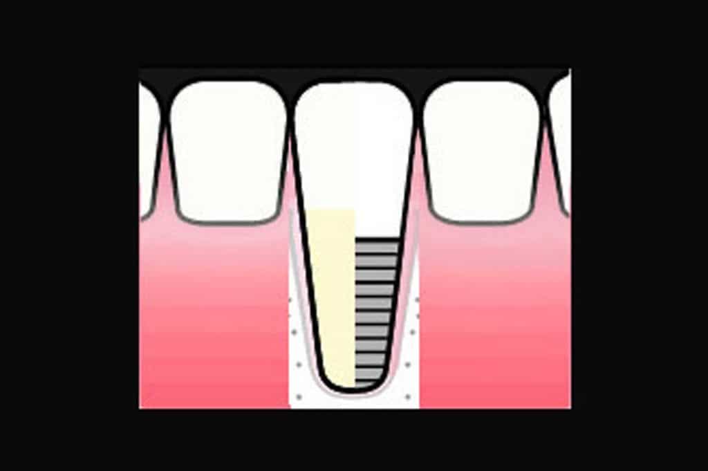Ved Kolbotn Tannklinikk viser illustrasjonen oppbyggingen av tannimplantat versus naturlig tann – informasjon for pasienter i Kolbotn, Follo, Nordstrand og Sofiemyr.