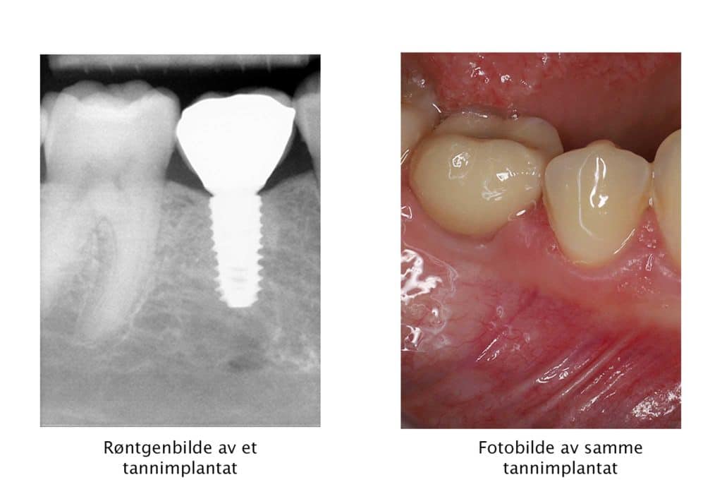 Galleri: Hos Kolbotn Tannklinikk vises tannimplantat i både røntgen og foto – pasienter i Kolbotn, Follo, Vinterbro og Nordstrand.