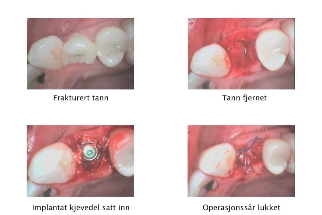 Galleri: Ved Kolbotn Tannklinikk dokumenteres hvordan en frakturert tann erstattes med implantat – Kolbotn, Oppegård, Sofiemyr og Holmlia.