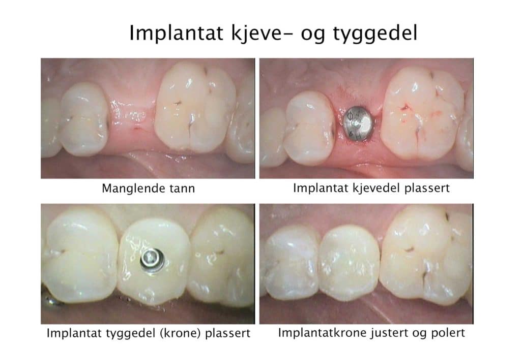 Galleri: Tannlegene på Kolbotn Tannklinikk viser behandling fra implantat til ferdig krone – Kolbotn, Follo, Greverud og Myrvoll.