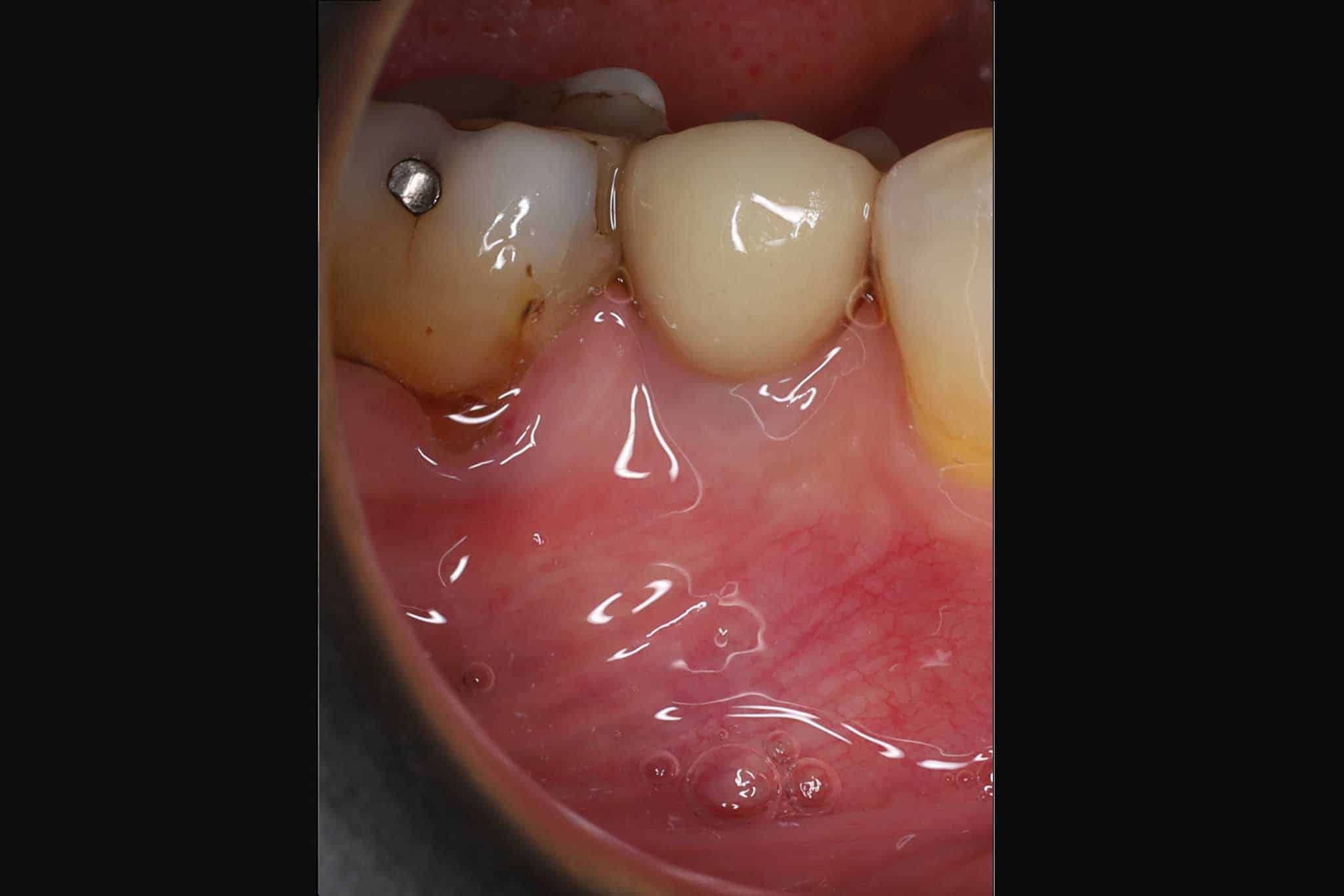 4-1-2-Kolbotn-Tannklinikk-Kunstig-Tann-Tannimplantat-Implantat Før- og etterbilde: Tannlegene ved Kolbotn Tannklinikk viser implantat i foto og røntgen – pasienter i Kolbotn, Follo, Myrvoll og Greverud.