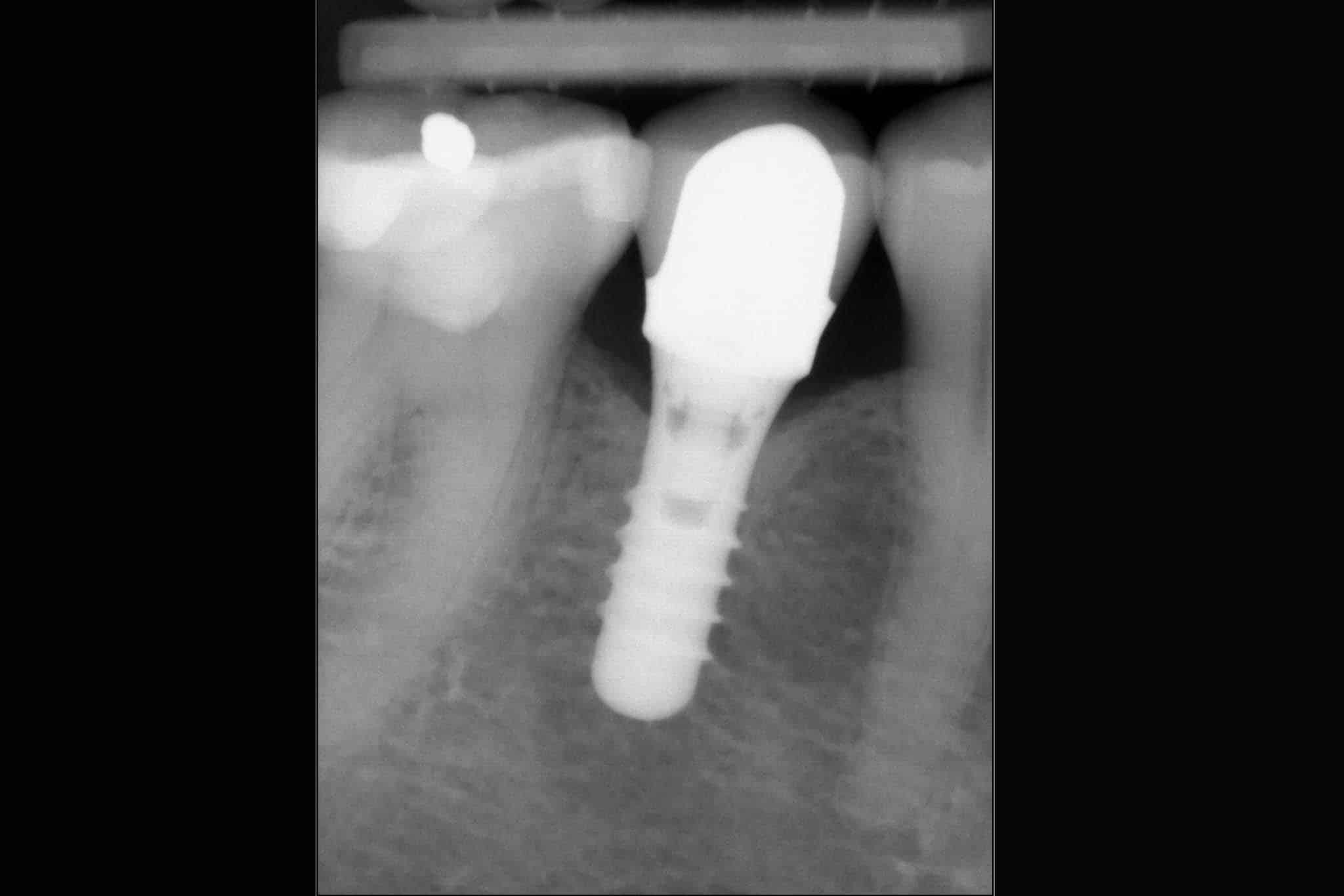 Før- og etterbilde: Tannlegene ved Kolbotn Tannklinikk viser implantat i foto og røntgen – pasienter i Kolbotn, Follo, Myrvoll og Greverud.