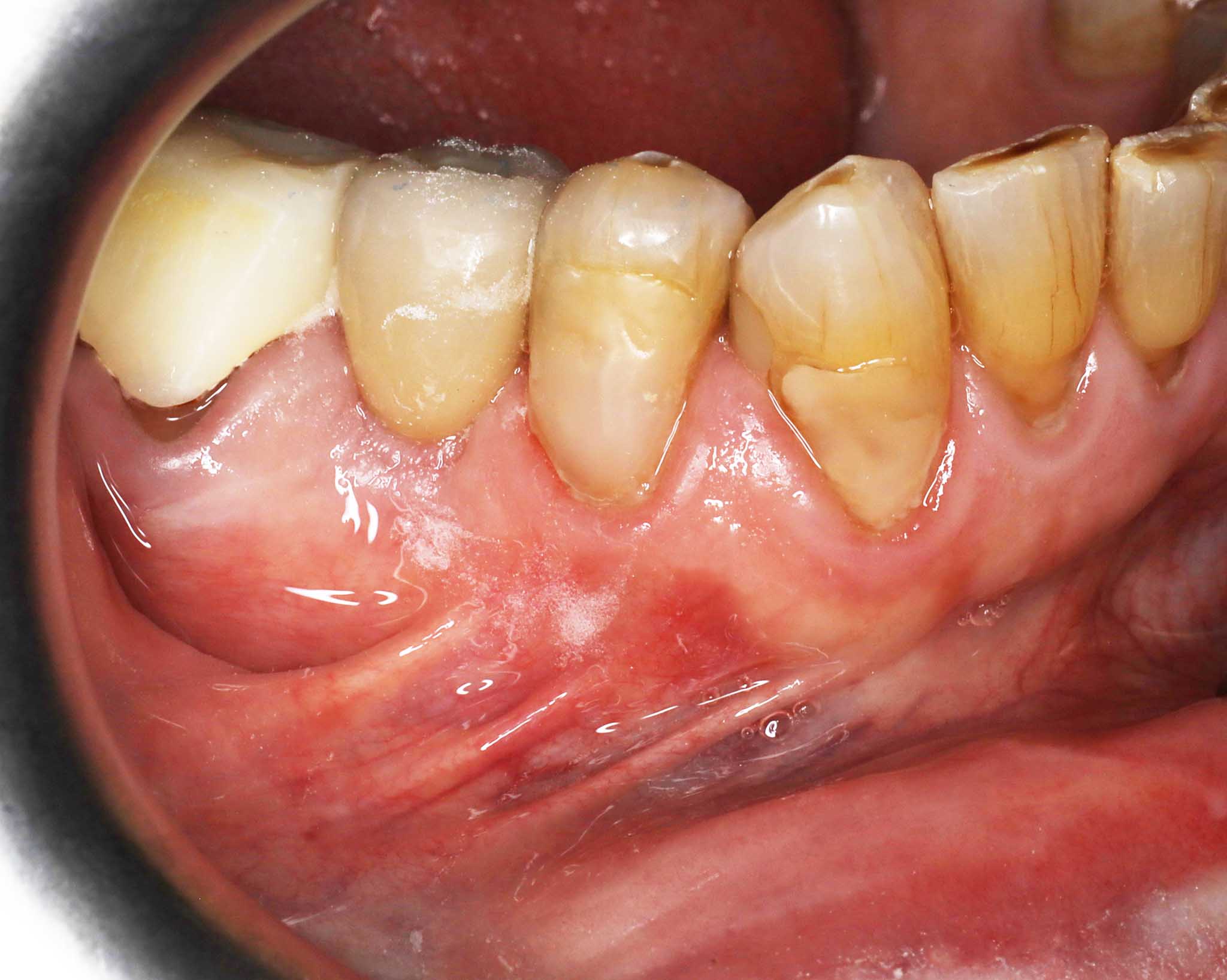Før- og etterbilde: Ved Kolbotn Tannklinikk viser tannlegene implantatresultat på røntgen og foto – pasienter i Kolbotn, Vinterbro, Nordstrand og Sofiemyr.