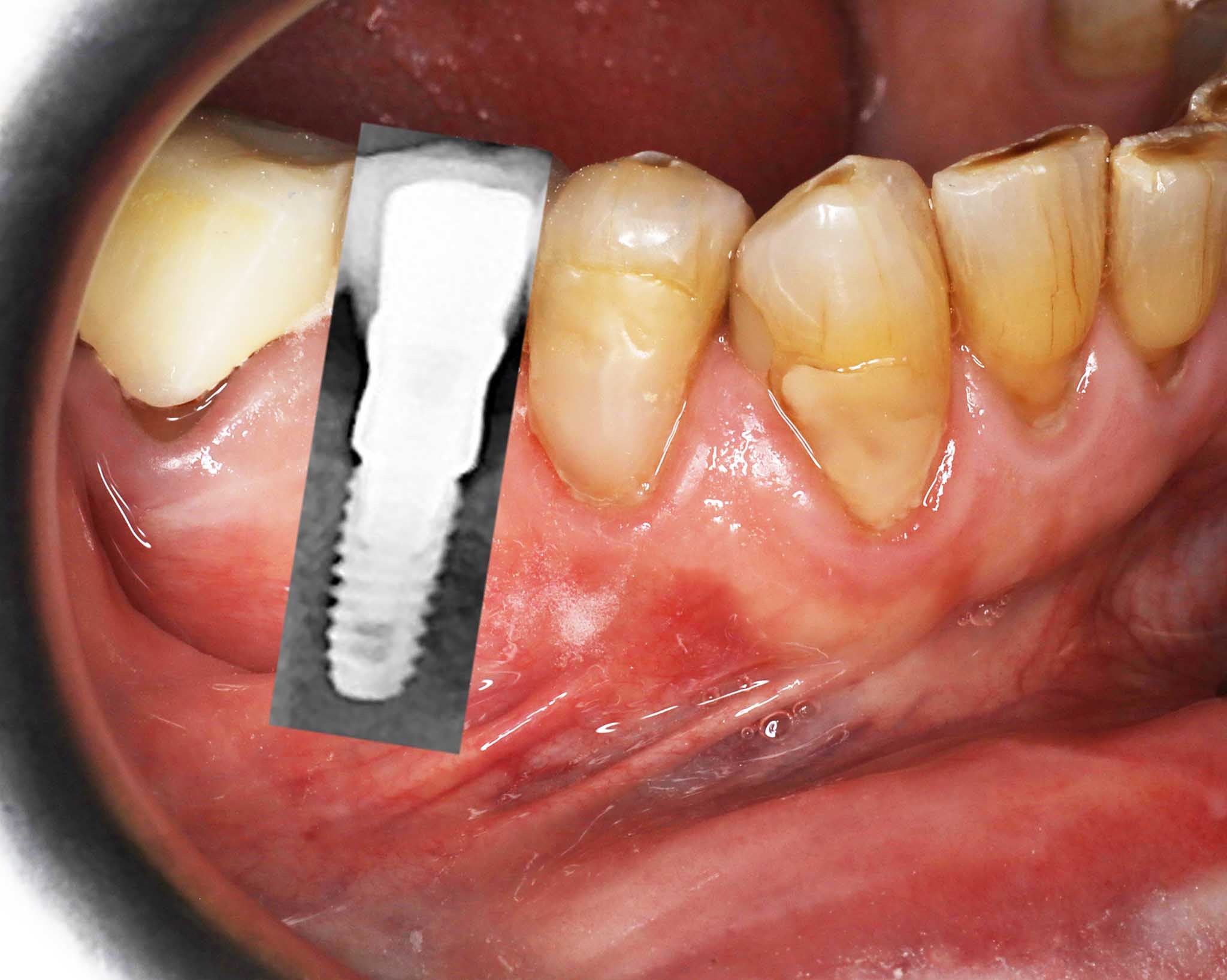 4-1-7-Kolbotn-Tannklinikk-Kunstig-Tann-Tannimplantat-Implantat Før- og etterbilde: Ved Kolbotn Tannklinikk viser tannlegene implantatresultat på røntgen og foto – pasienter i Kolbotn, Vinterbro, Nordstrand og Sofiemyr.