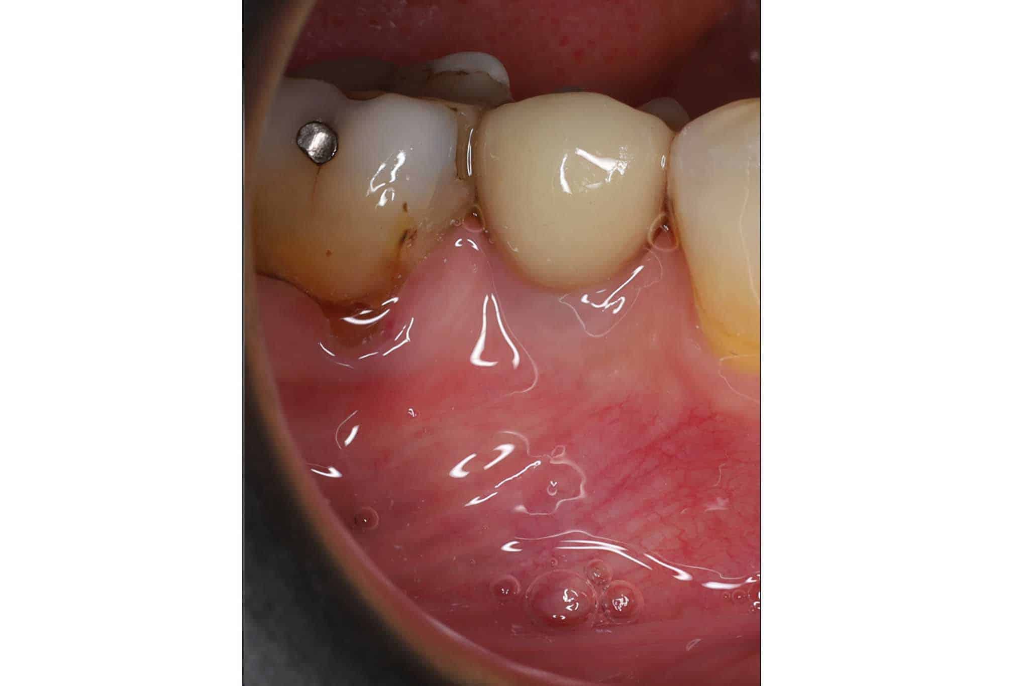 Før- og etterbilde: Tannleger på Kolbotn Tannklinikk viser implantatbehandling – Kolbotn, Follo, Greverud og Hauketo.