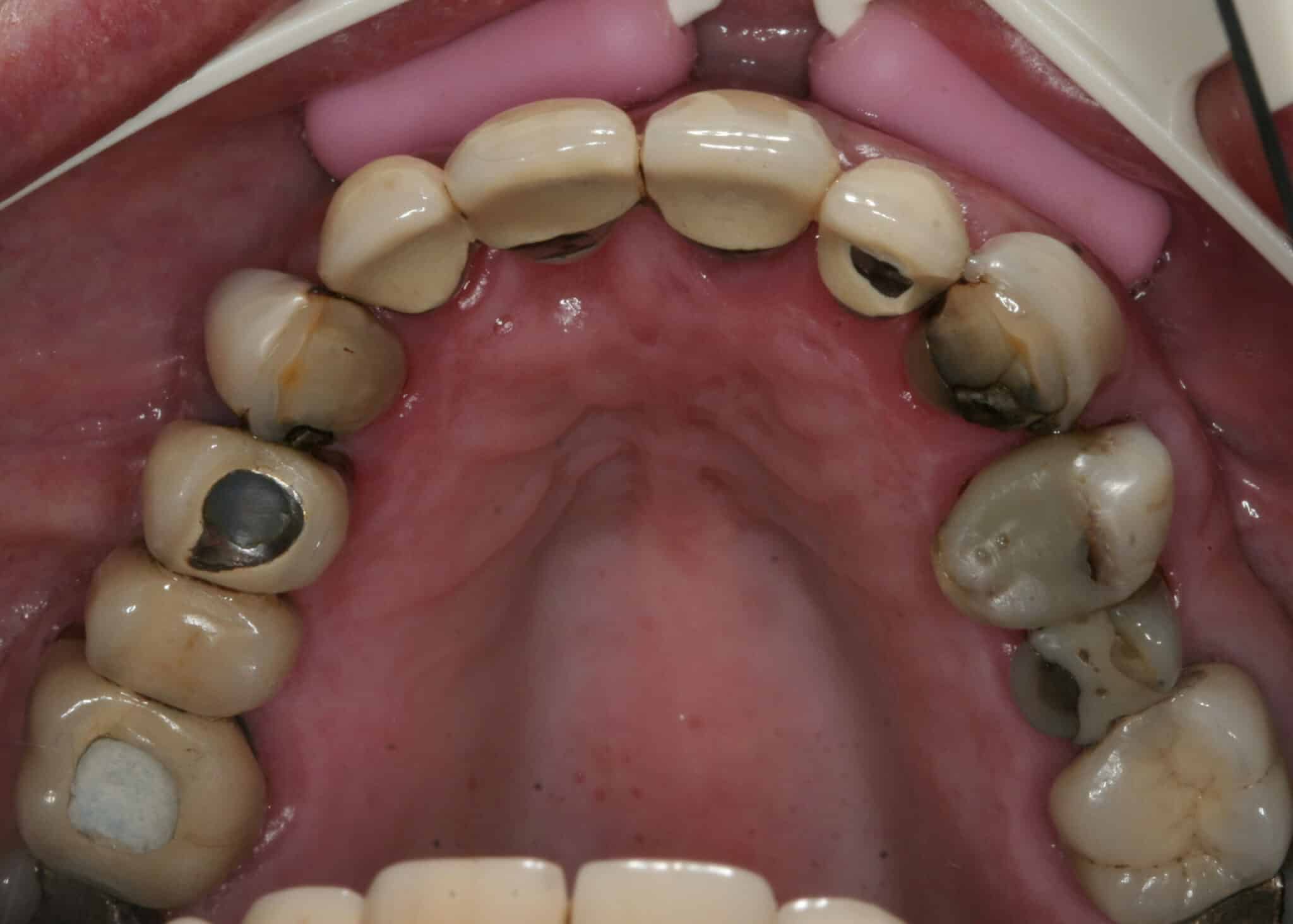 Overkjeve behandlet med stor brokonstruksjon.