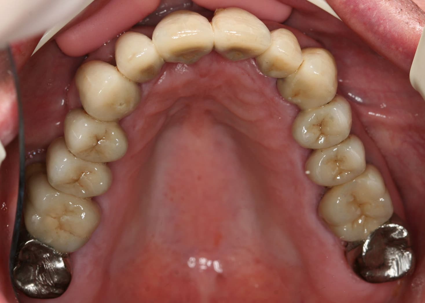 Før- og etterbilde: På Kolbotn Tannklinikk erstattes dårlige og tapte tenner med en hesteskoformet bro – varig løsning i Kolbotn, Follo og Nordstrand.