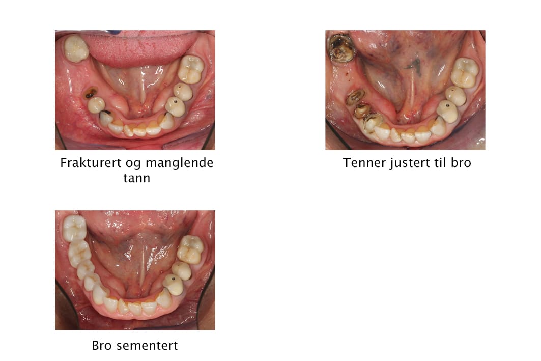 Galleri: På Kolbotn Tannklinikk settes bro i underkjeven – behandling i Kolbotn, Vinterbro og Holmlia.