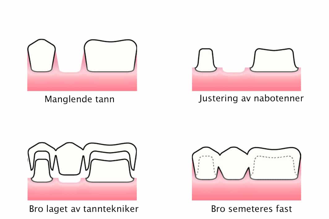 Galleri: Ved Kolbotn Tannklinikk brukes bro som erstatning for en manglende tann – trygg løsning i Kolbotn, Follo og Myrvoll.