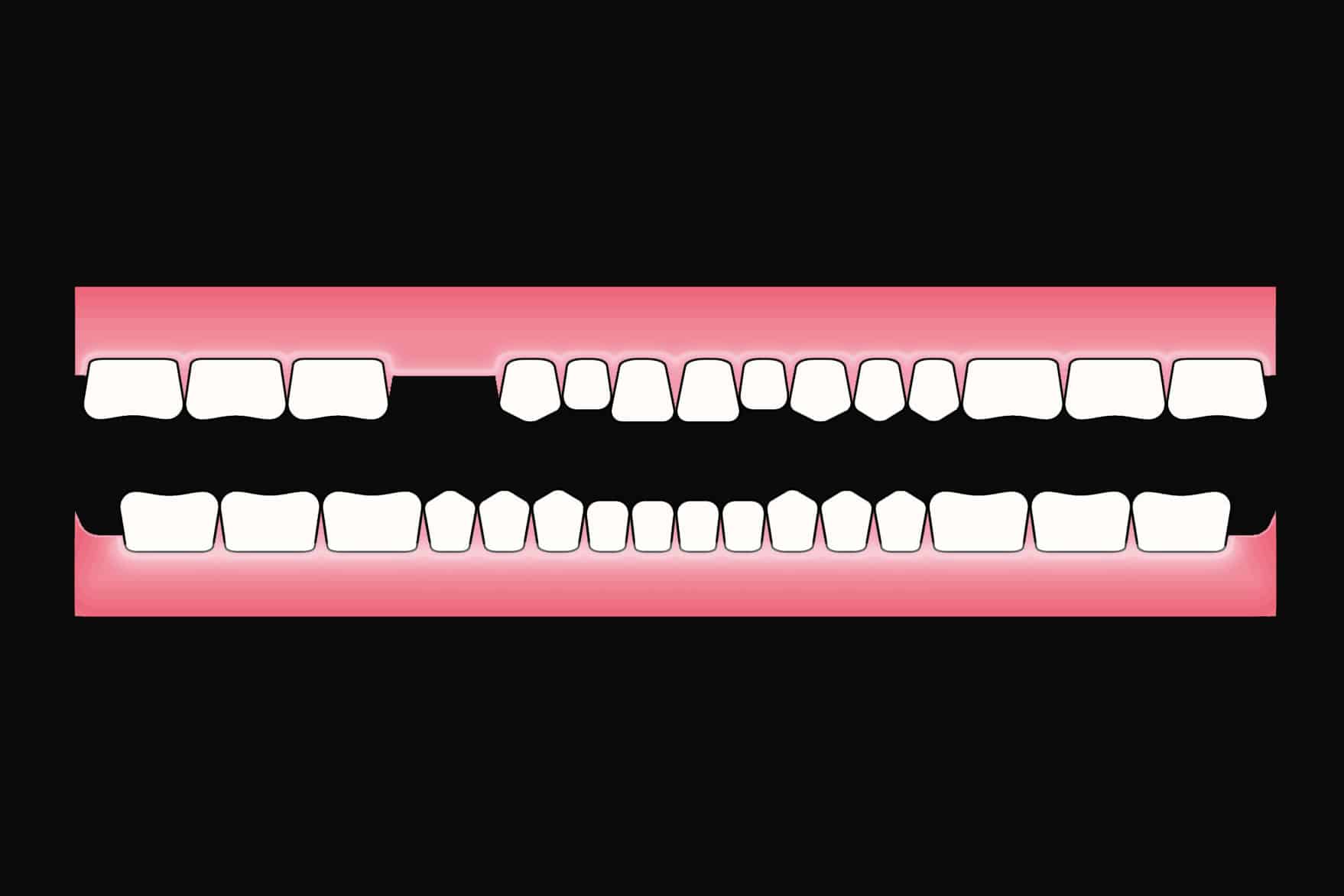 To små jeksler erstattet med kromkobolt delprotese.