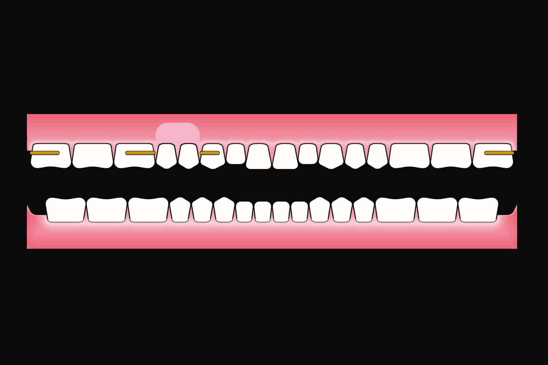 Før- og etterbilde: Ved Kolbotn Tannklinikk erstattes to små jeksler med en kromkobolt delprotese – behandling i Kolbotn, Vinterbro og Holmlia.