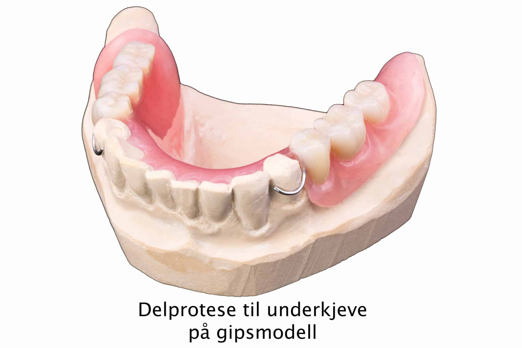 Ved Kolbotn Tannklinikk tilbys trådklammer delprotese som en rimelig og fleksibel løsning – behandling i Kolbotn, Oppegård og Nordstrand.
