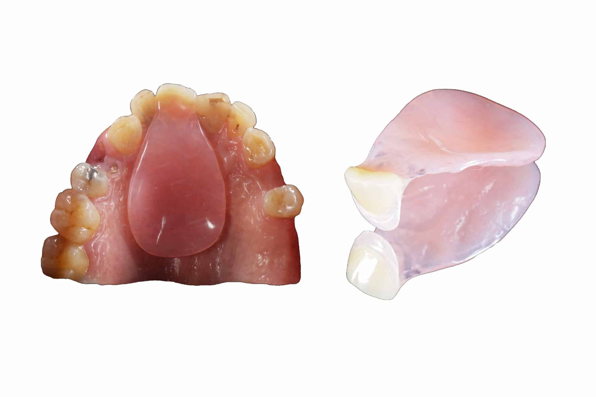 Hos Kolbotn Tannklinikk brukes spoon denture som kortvarig løsning for fortenner – behandling i Kolbotn, Follo og Myrvoll.