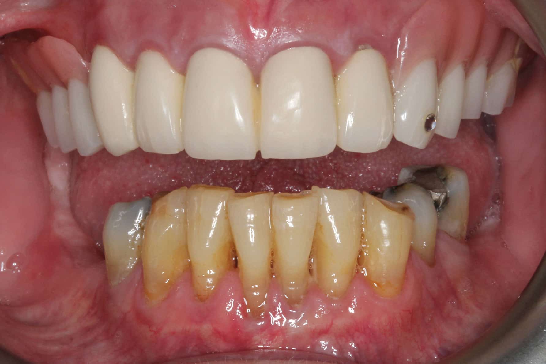 Før- og etterbilde: På Kolbotn Tannklinikk vises konusprotese med kapper som festes til tennene – behandling i Kolbotn, Follo og Nordstrand.