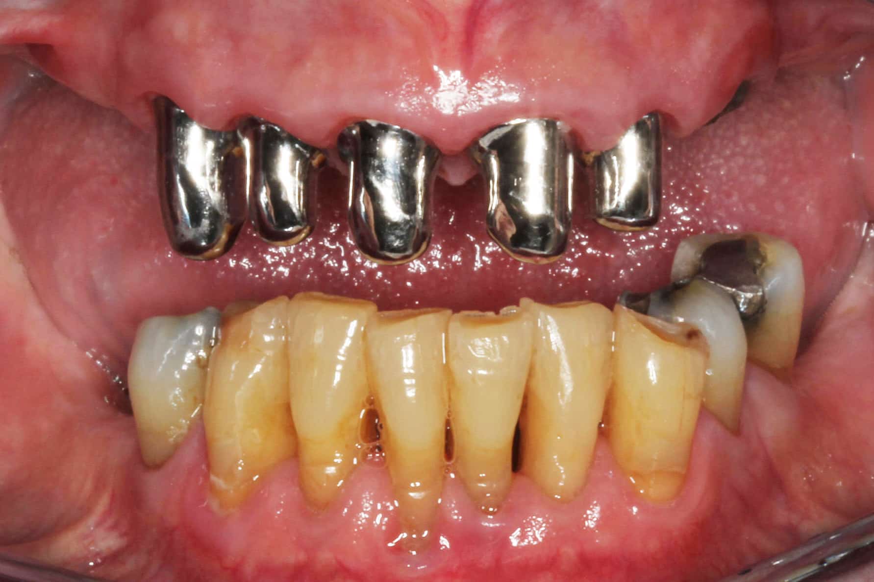 Før- og etterbilde: På Kolbotn Tannklinikk vises konusprotese med kapper som festes til tennene – behandling i Kolbotn, Follo og Nordstrand.